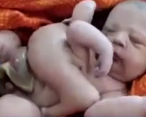 Inde : Un bébé doté de quatre bras et de quatre jambes suscite l'étonnement et l'incrédulité de la population locale